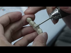 Μεταλλική κεραμική γέφυρα